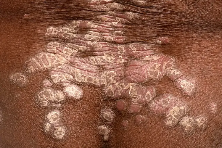 photo of psoriasis