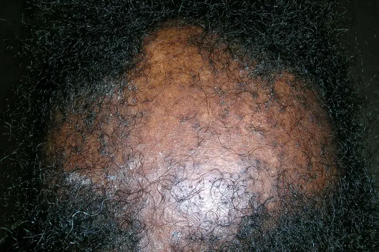 photo of Post-Inflammatory Hyperpigmentation (PIH)