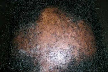 Central centrifugal cicatricial alopecia (CCCA) is a form of alopecia.