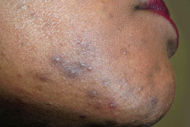 photo of Post-inflammatory hyperpigmentation (PIH)