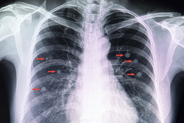 X-ray of lung nodules