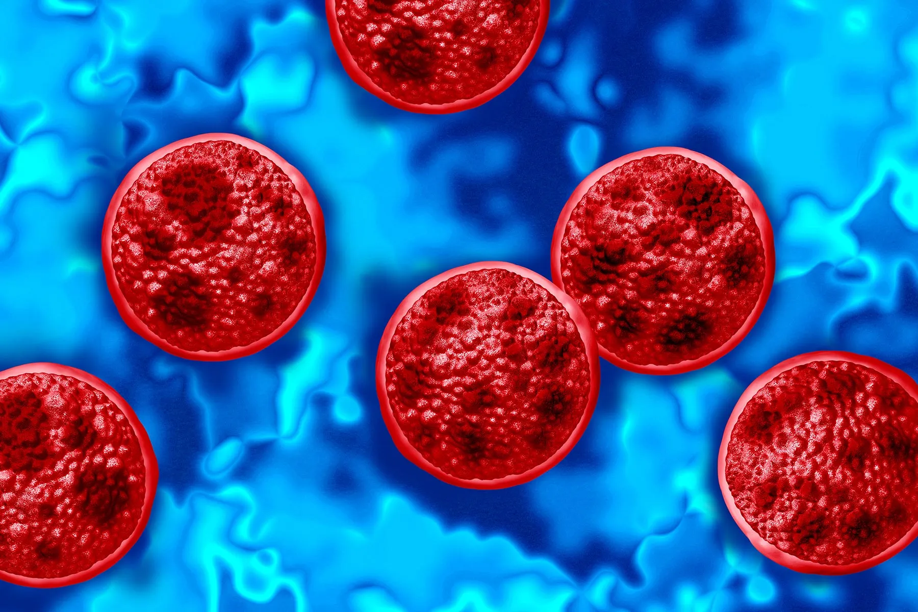 What Is Cyclosporiasis?