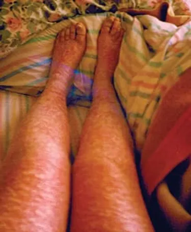 Irene Prantalos's legs before her psoriasis healed.