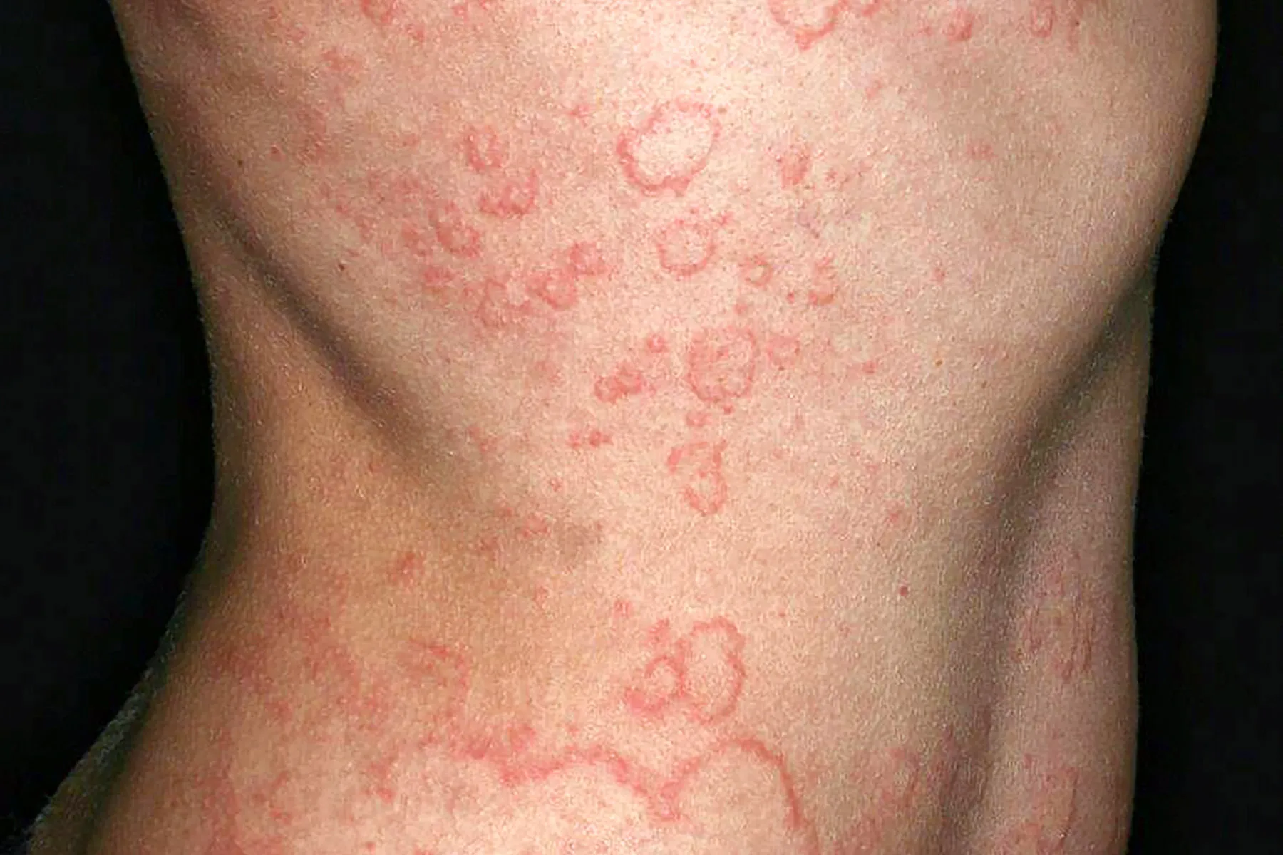 Chronic Spontaneous Urticaria What To Know Saperap