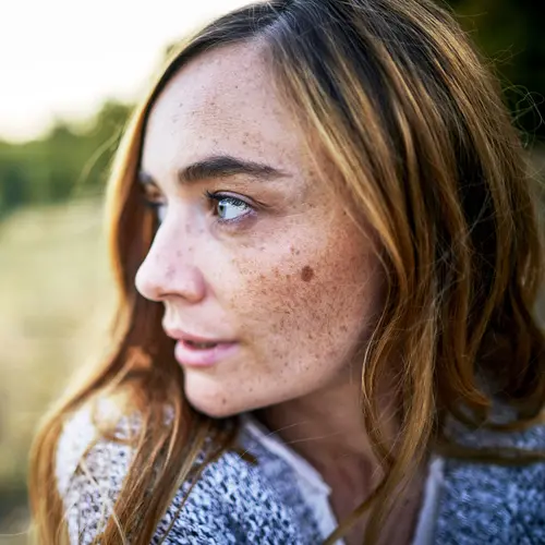 photo of woman with melasma on face