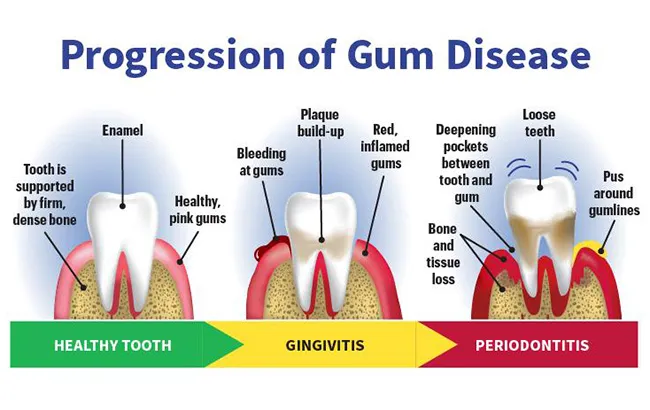 infographic on gum disease