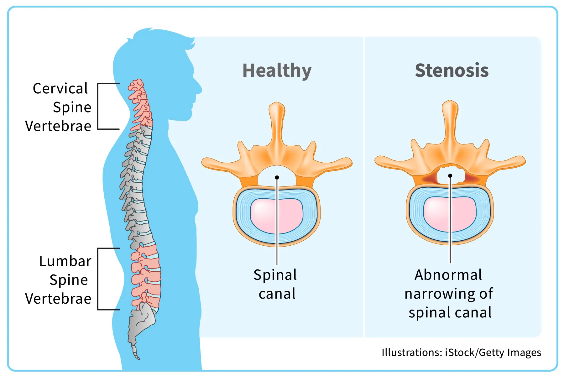 infographic on spinal stenosis