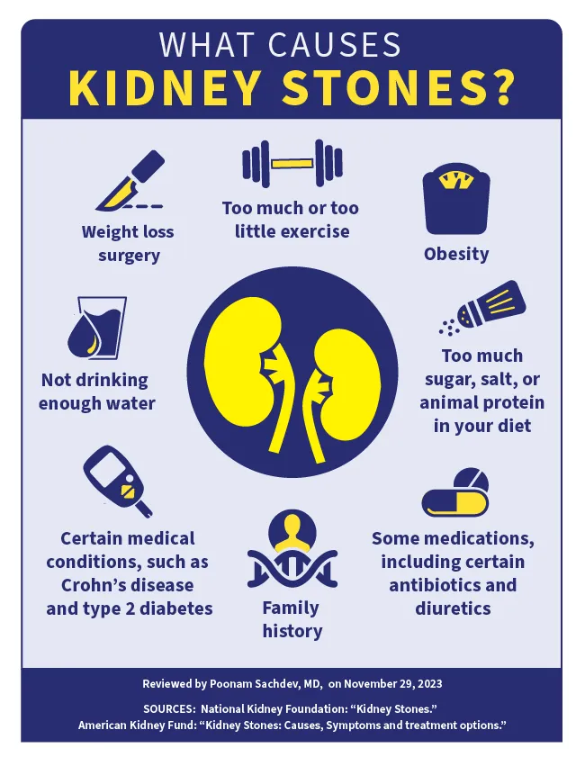 infographic of kidney stones