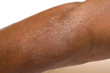 Eczema on darker skin can look purple, grayish, or darker brown