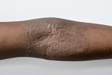 Eczema on child's arm