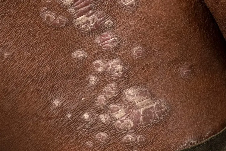 photo of psoriasis on poc