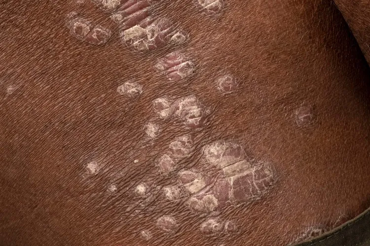 photo of psoriasis on poc