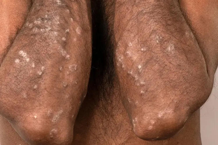 photo of psoriasis on poc