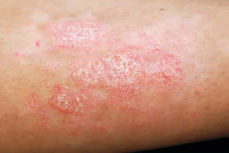 photo of healing psoriasis