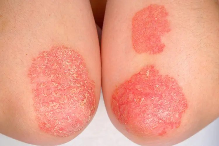 photo of psoriasis on elbow