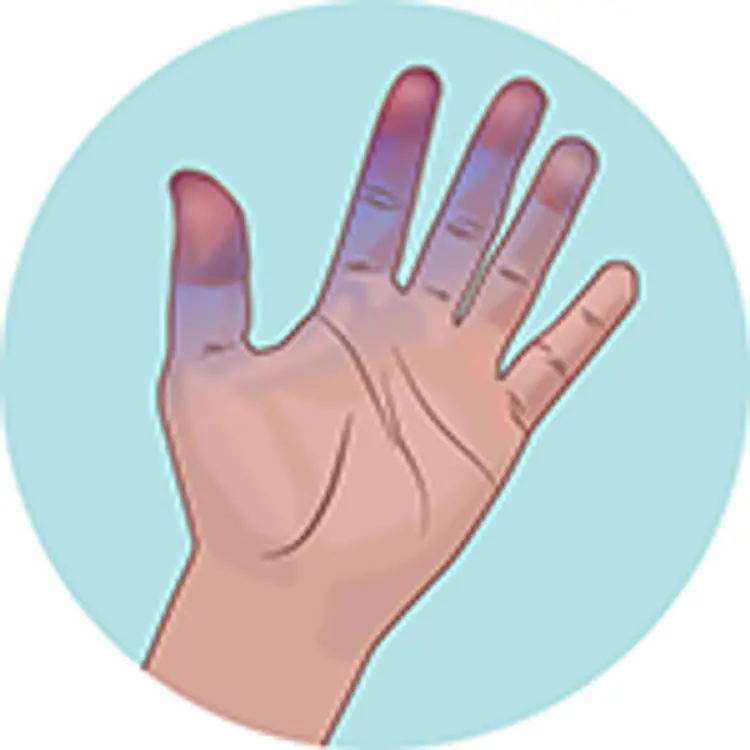 illustration of discolored fingers