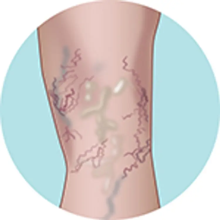 illustration of varicose veins