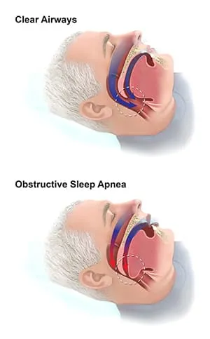 clear airways v obstructive sleep apnea comparison