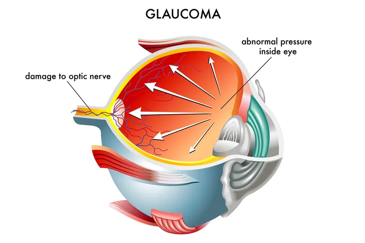 photo of Glaucoma