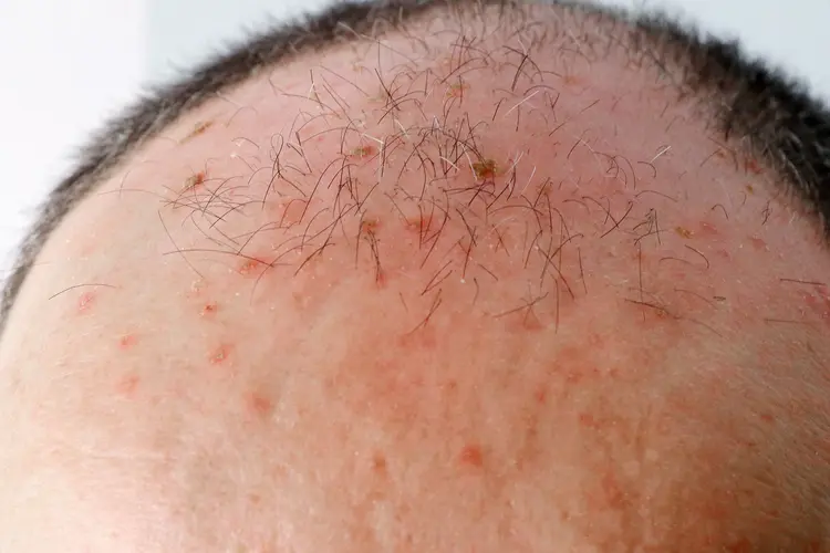 photo of actinic keratosis