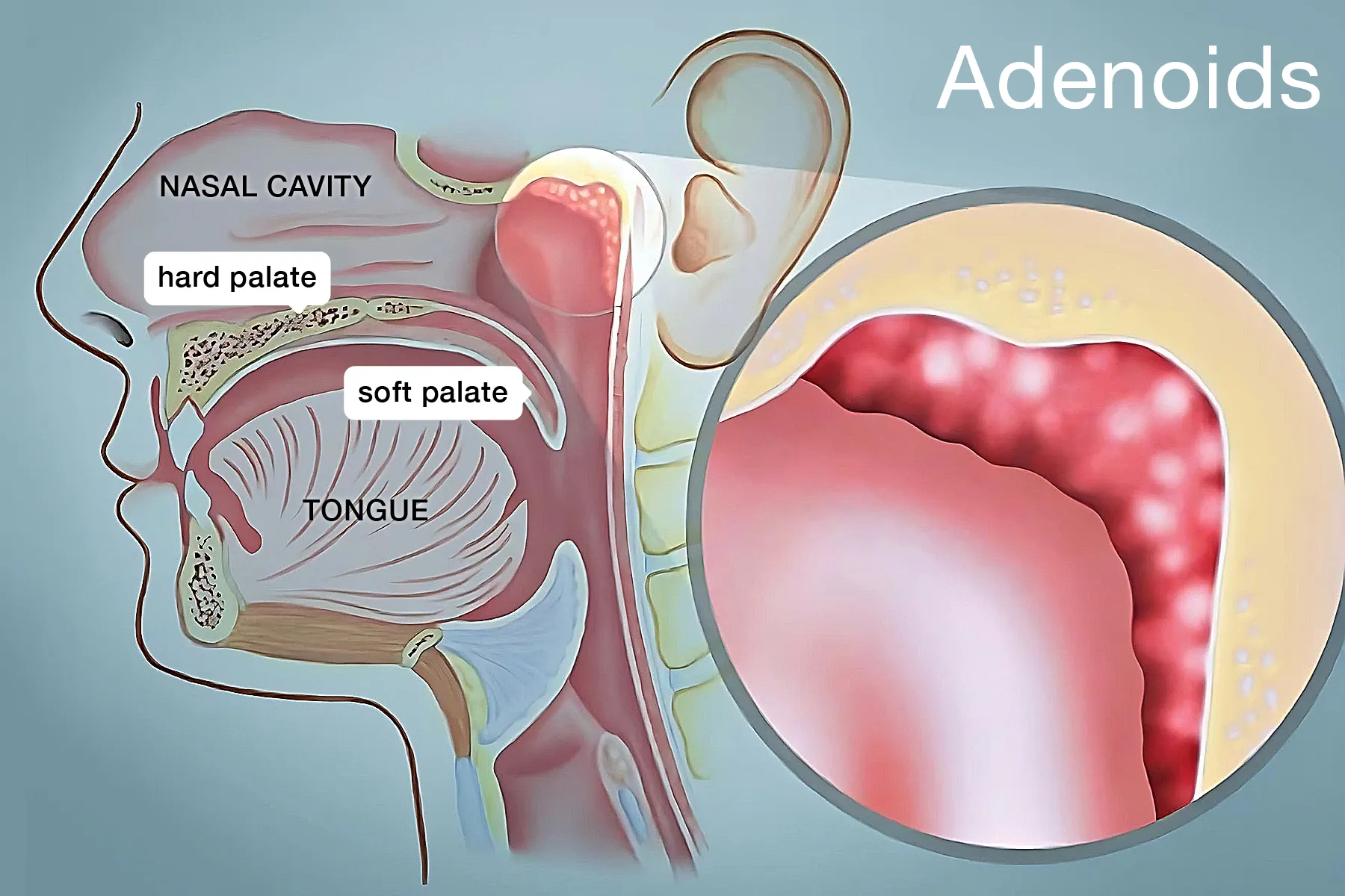 photo of Adenoids