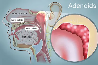 Adenoids are a mass of tissue that, along with your tonsils, help keep you healthy by trapping harmful germs that pass through the nose or mouth.