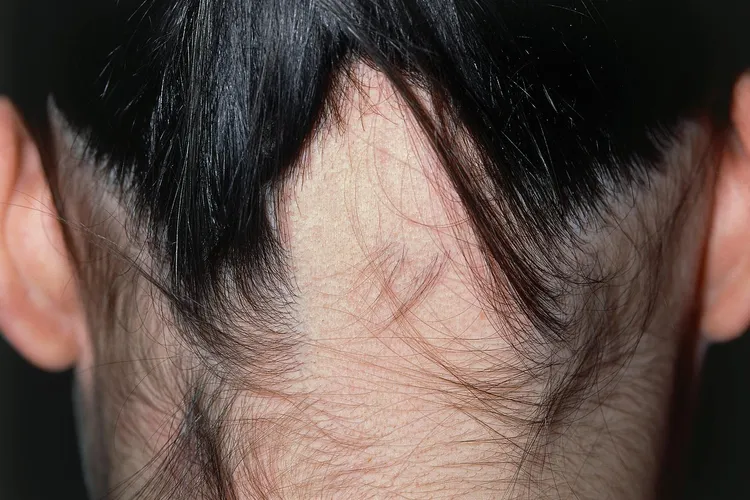 photo of alopecia areata