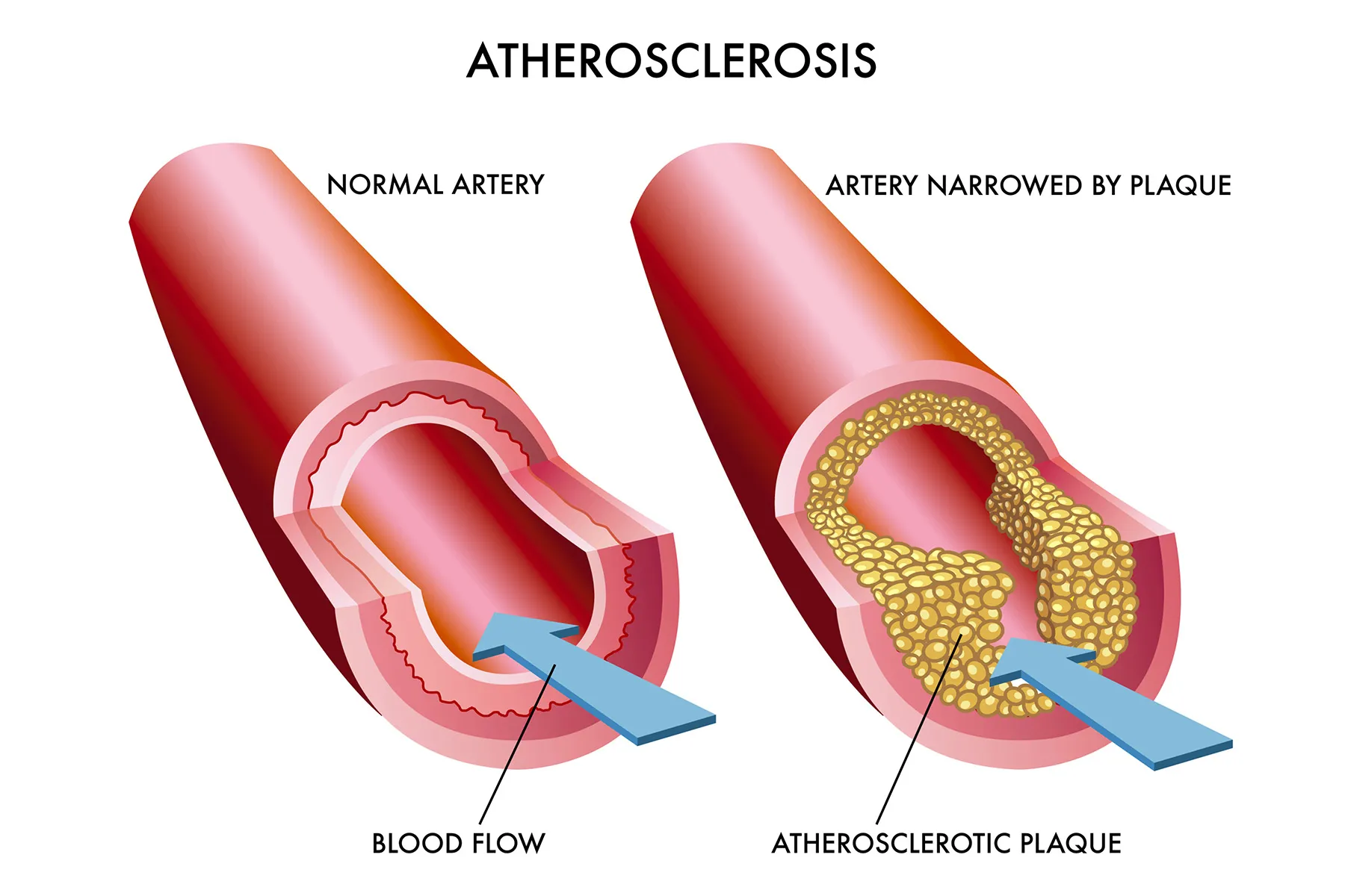 photo of Illustration of the effects of atheroscle