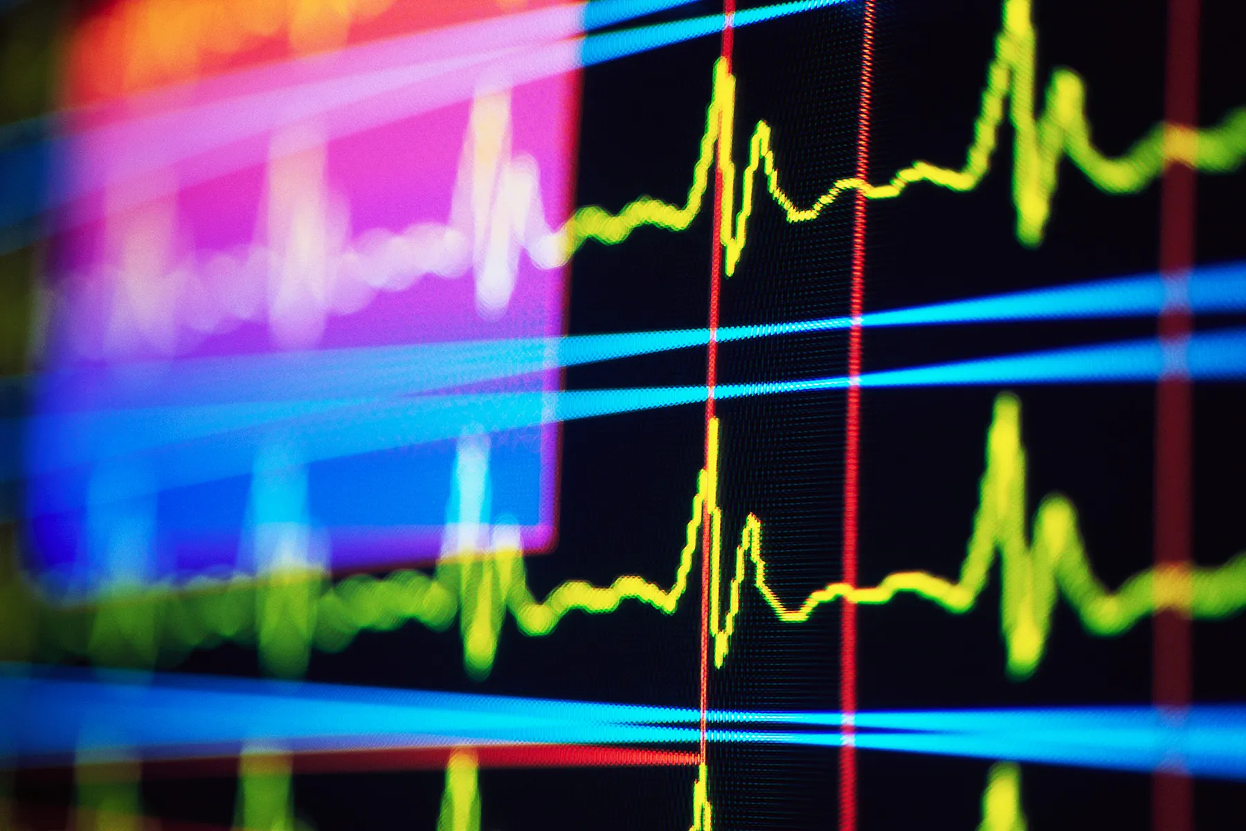 Electrocardiogram (EKG or ECG) Tests: Purpose & Types