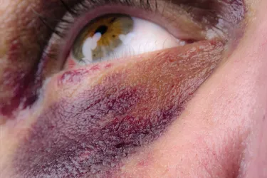 Most of the time, a black eye will clear up on its own. (Photo Credit: Bryan Steffy / Getty Images)