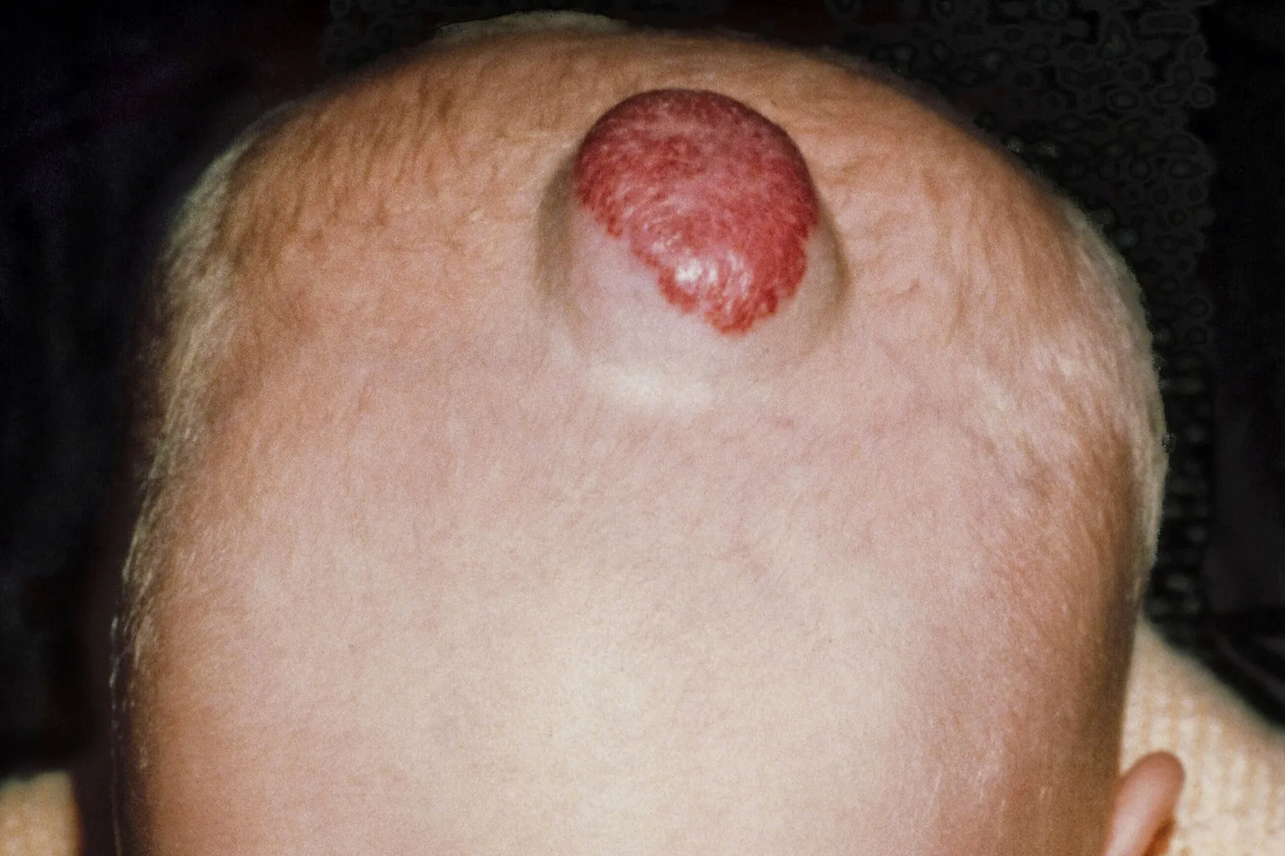 photo of Cavernous hemangioma