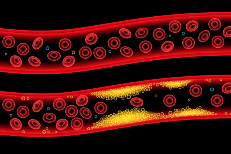 photo of Normal artery vs cholesterol artery