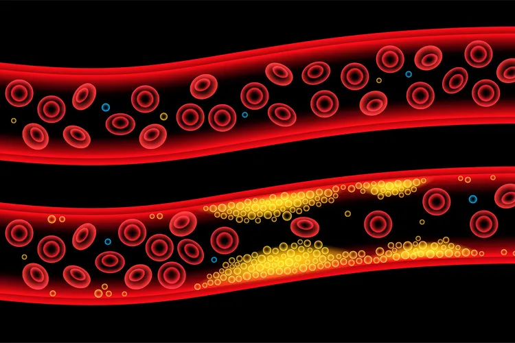 photo of Normal artery vs cholesterol artery