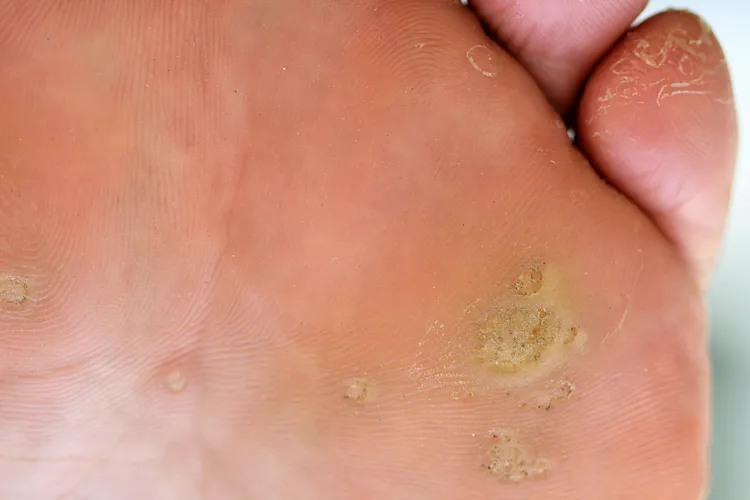 photo of Dry and cracked soles of feet