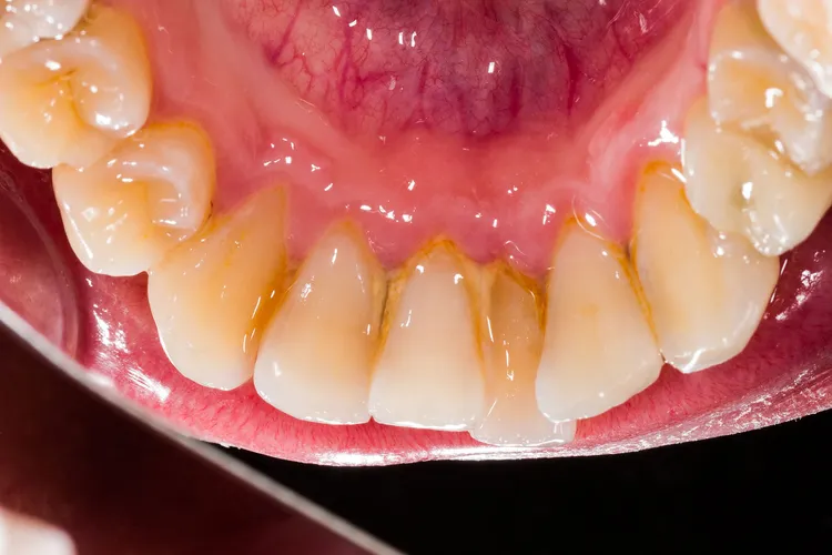 photo of plaque and tartar on teeth