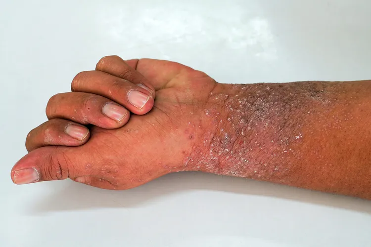 photo of Eczema present on the hand and palms.