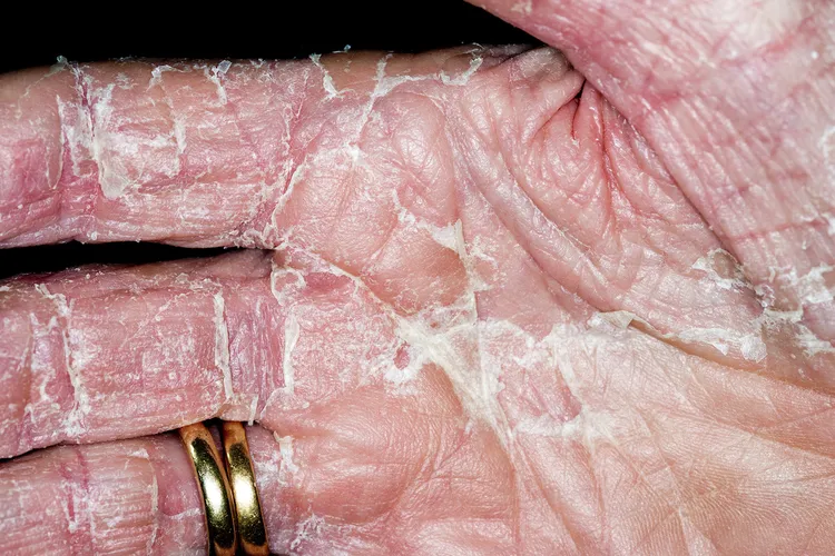 photo of Exfoliative dermatitis of the hand.