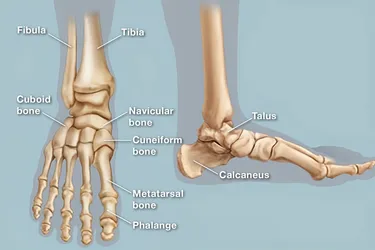 Broken or dislocated bones in your feet are one possible cause of fallen arches. (Photo credit: WebMD)