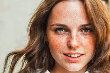 Freckles are more likely if you’re light-skinned with blond or red hair. But anyone can have them—on darker skin, they’ll show up as darker brown spots. (Photo credit: Irina Bogolapova/Dreamstime)