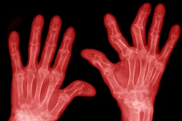 Rheumatoid arthritis in the hands and fingers can cause so much damage to joints that they become deformed.