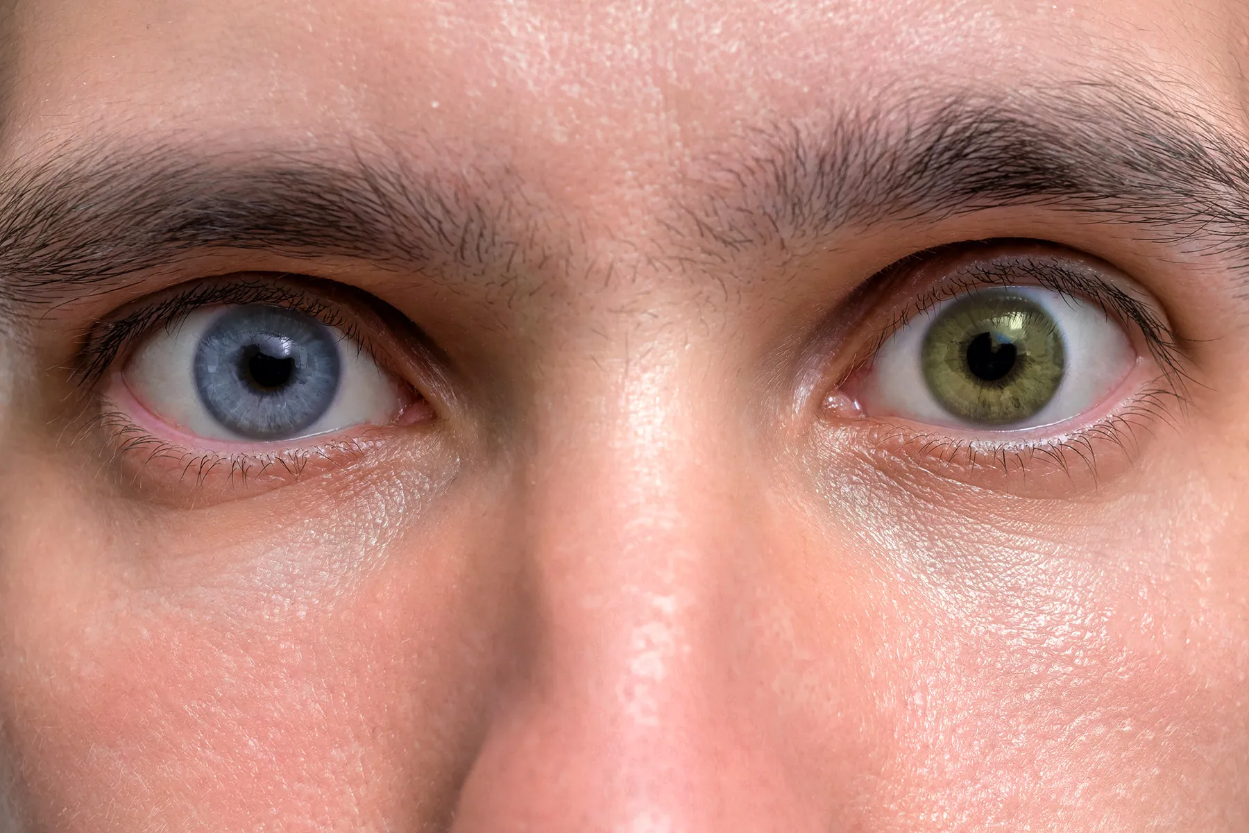 photo of heterochromia