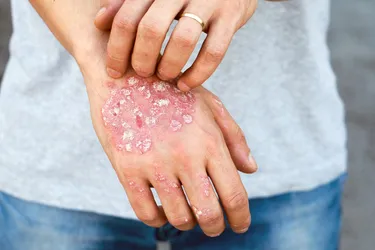 Severe eczema can crack and bleed leading to infections. Photo credit: 2Ban/Getty Images