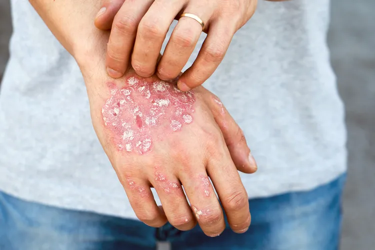 photo of dry flaky skin on hand with psoriasis