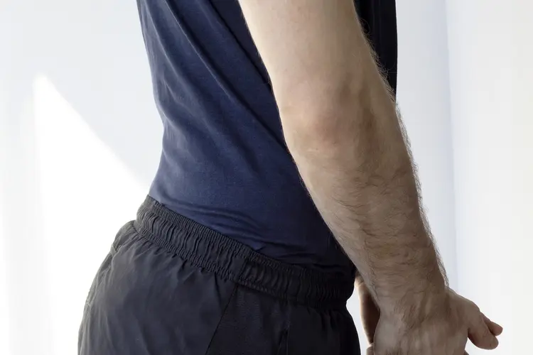 photo of hyperlordosis