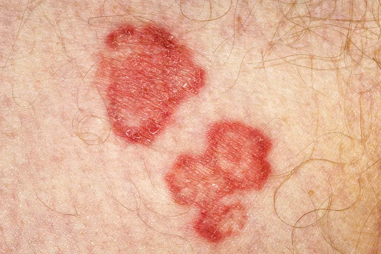 photo of a ringworm (tinea) infection of the groin