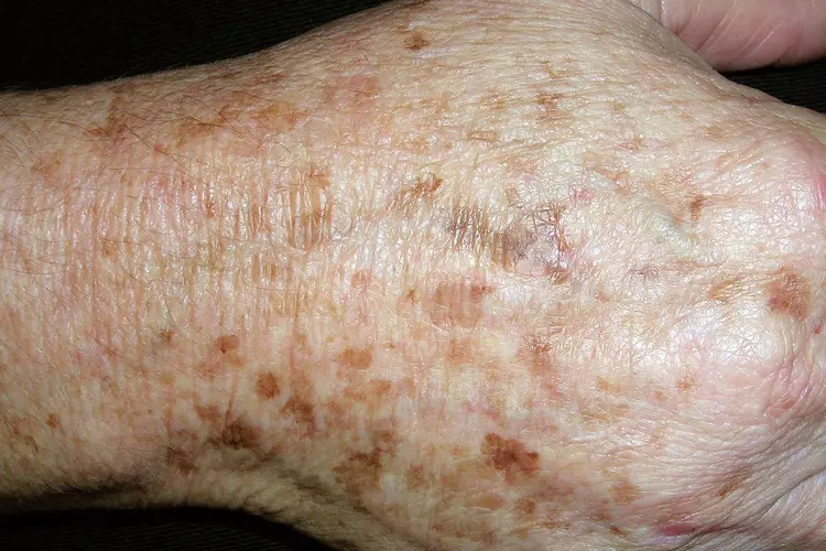 photo of  lentigines on senior hand