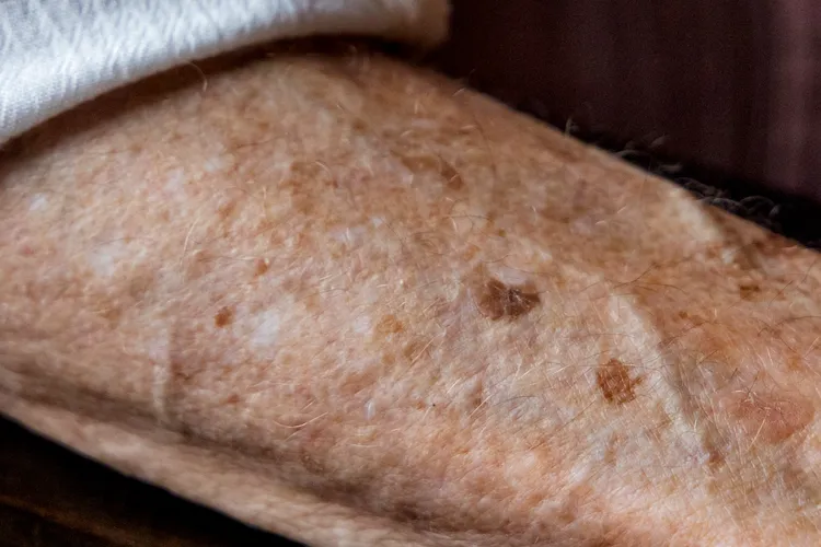photo of Liver spots on the arm of elderly woman