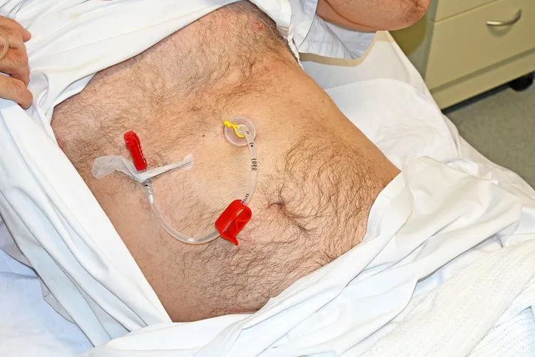 photo of man wearing gastric feeding tube