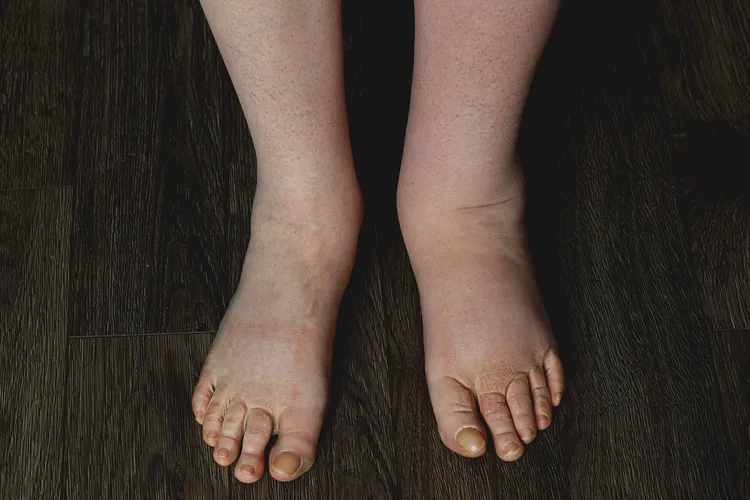 photo of woman's feet with lymphedema condition