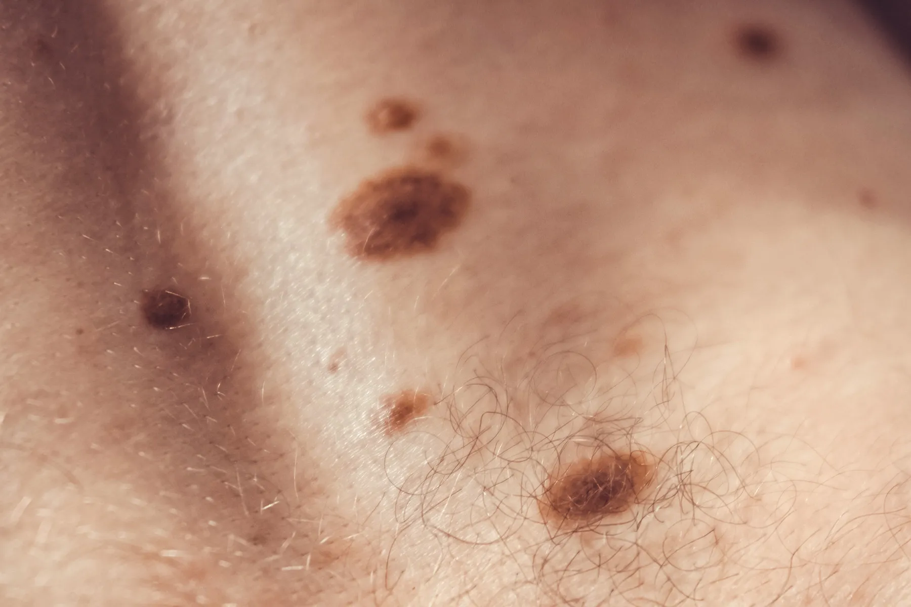 photo of Melanocytic nevus